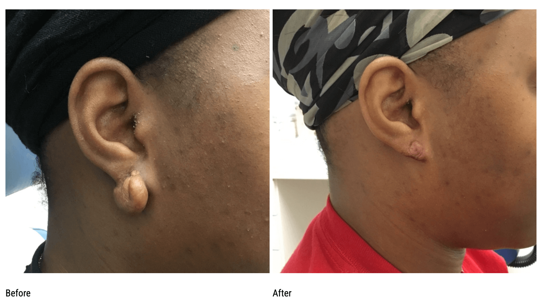 Keloid excision before and aft